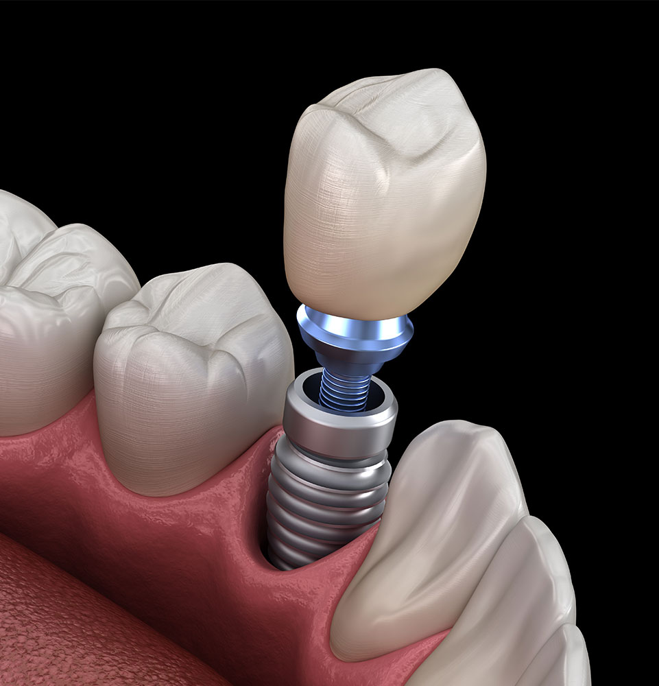 3D rendering of a dental implant placed in the jawbone
