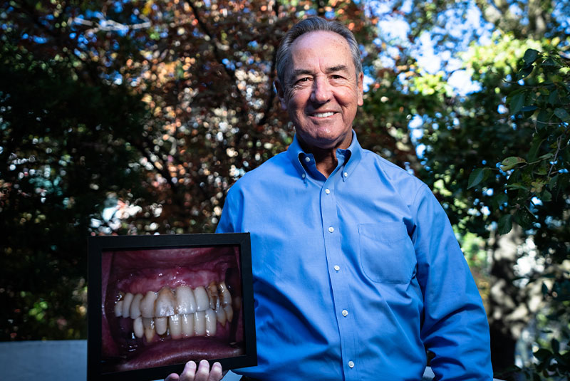 Patient Tony's smile before and after full-arch dental implants