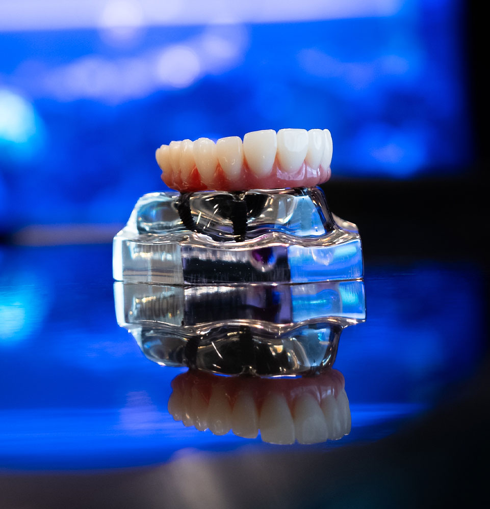 All-on-X full-arch dental implant model used by Dr. Alijanian